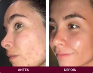 ANTES 3