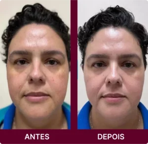 ANTES 5