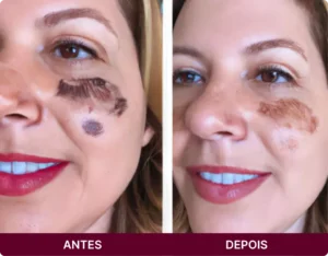 ANTES 6